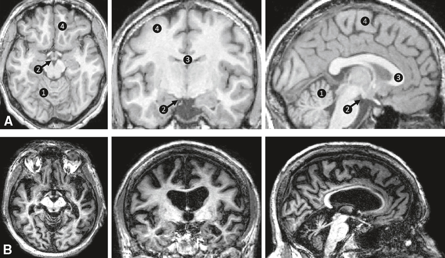 IRM montrant atrophie des corps mamillaires, thalamus et hippocampe, compatible avec un syndrome de Korsakoff.