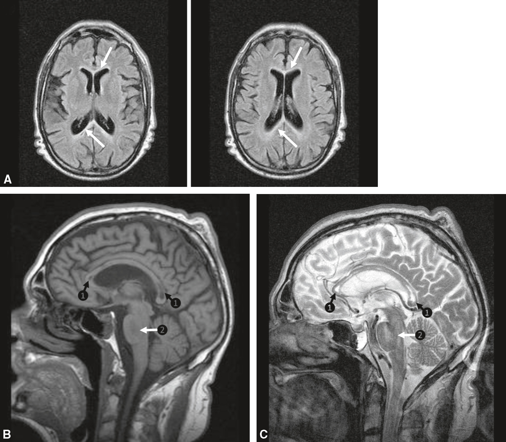 IRM montrant une atteinte démyélinisante symétrique du corps calleux, caractéristique de la maladie de Marchiafava-Bignami.