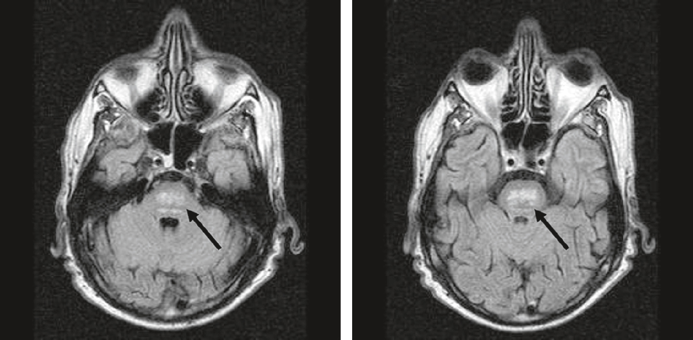 IRM montrant une lésion centrale du pont (flèches), évocatrice de myélinolyse centropontine liée à un trouble de l’équilibre osmotique.