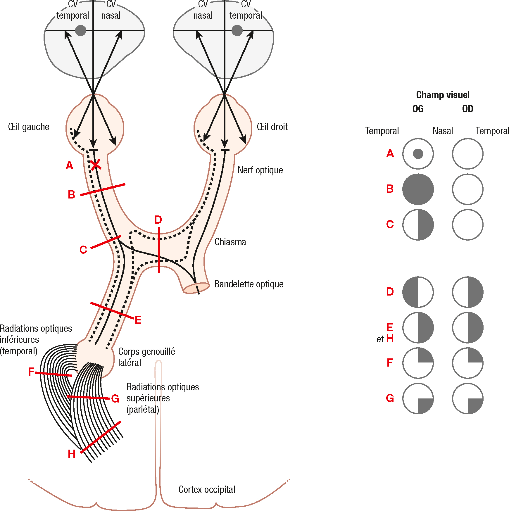 Schéma des voies visuelles montrant la correspondance entre la topographie des lésions et les altérations du champ visuel associées.