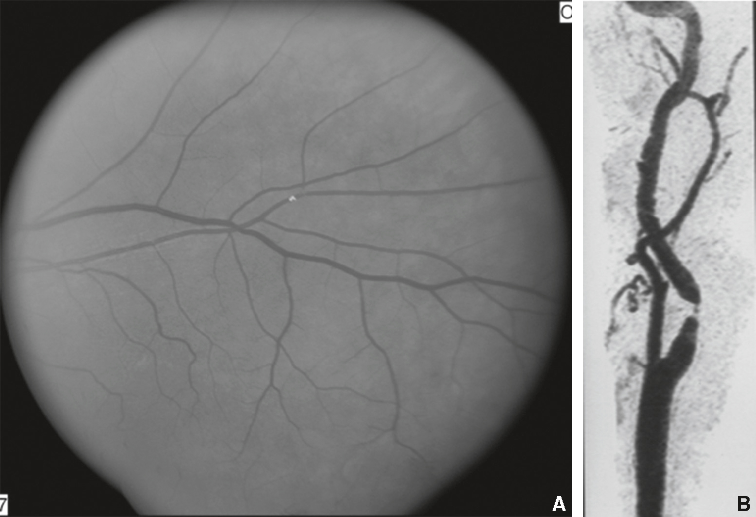 Images montrant une embolie rétinienne et une lésion carotidienne chez un patient présentant une amaurose fugace d’origine embolique.