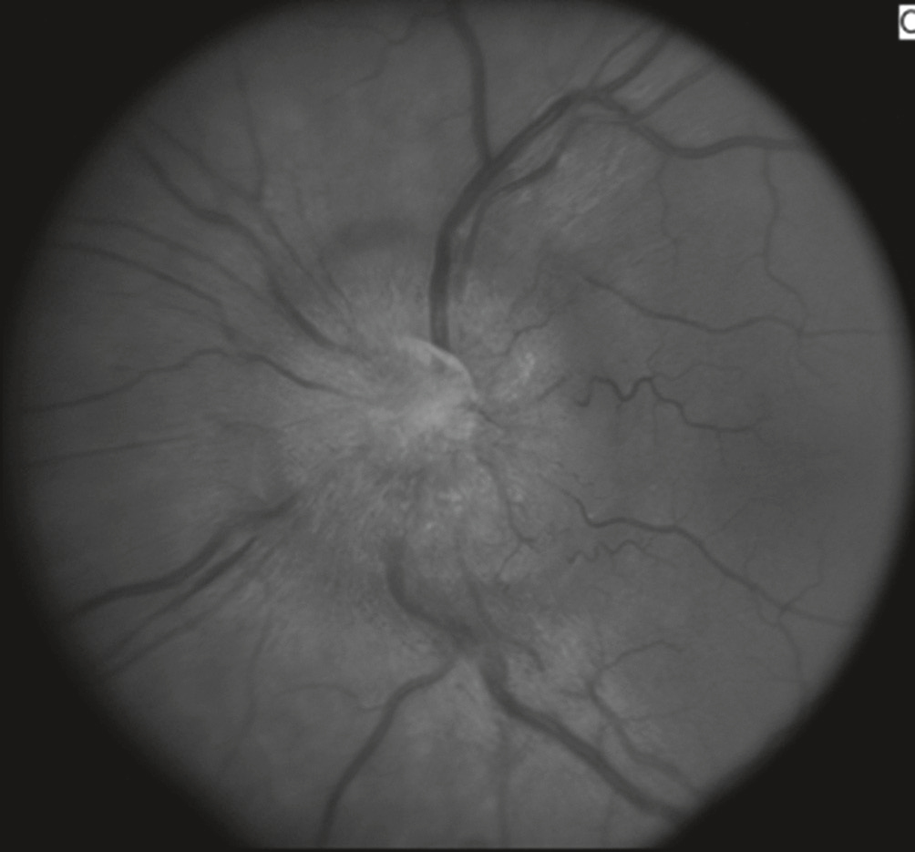 Fond d’œil révélant un œdème papillaire de stase avec disque optique flou, surélevé, bords effacés et vaisseaux dilatés, signe d’hypertension intracrânienne.