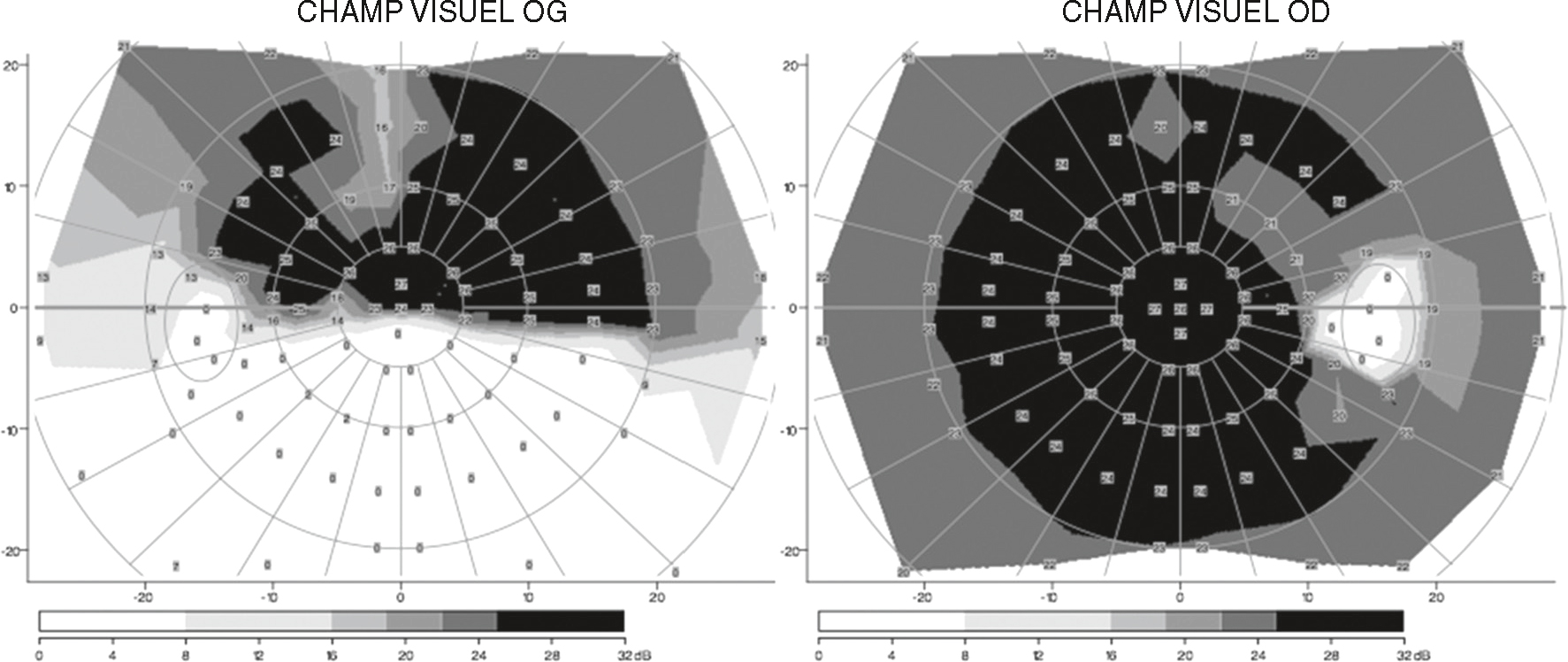 Déficit altitudinal inférieur du champ visuel gauche, compatible avec une neuropathie optique ischémique aiguë unilatérale.