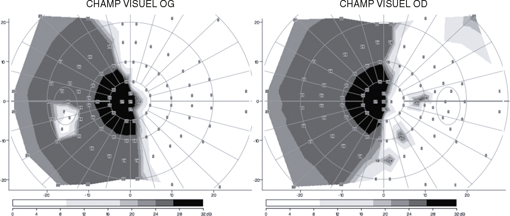 Représentation visuelle d’une hémianopsie latérale homonyme droite. Perte symétrique du champ visuel droit sur les deux yeux.