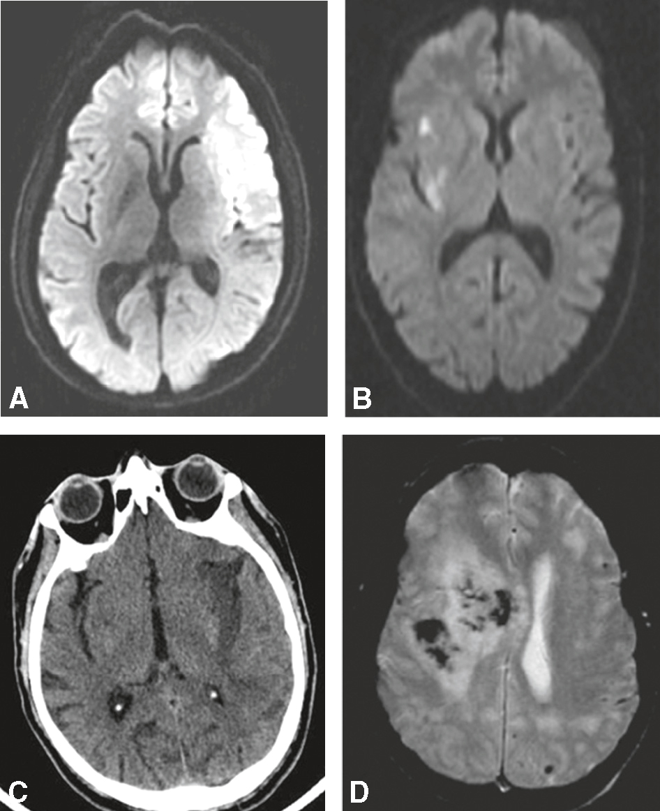 Les scans montrent des AVC ischémiques aigus, récents, chroniques et hémorragiques, aidant à différencier les types d'AVC pour un diagnostic précis.