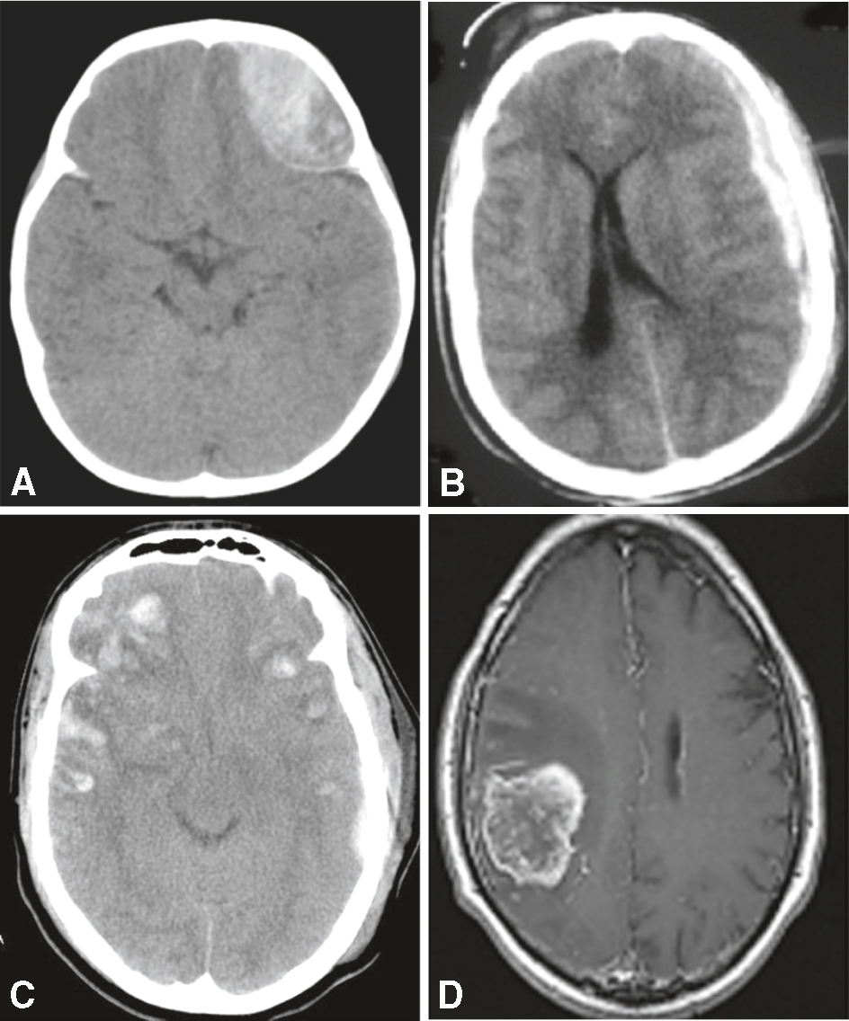 Les scans illustrent hémorragie cérébrale, AVC ischémique, œdème cérébral et tumeur, mettant en évidence leurs rôles dans les déficits neurologiques récents.