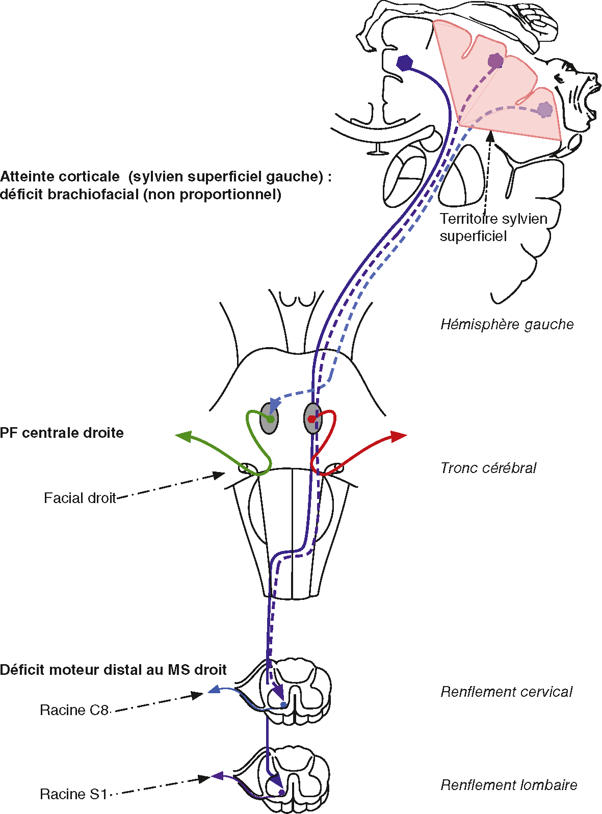 Atteinte corticale gauche causant un déficit moteur brachiofacial droit non proportionnel. Impliquant cortex moteur, tronc cérébral et projections spinales croisées.
