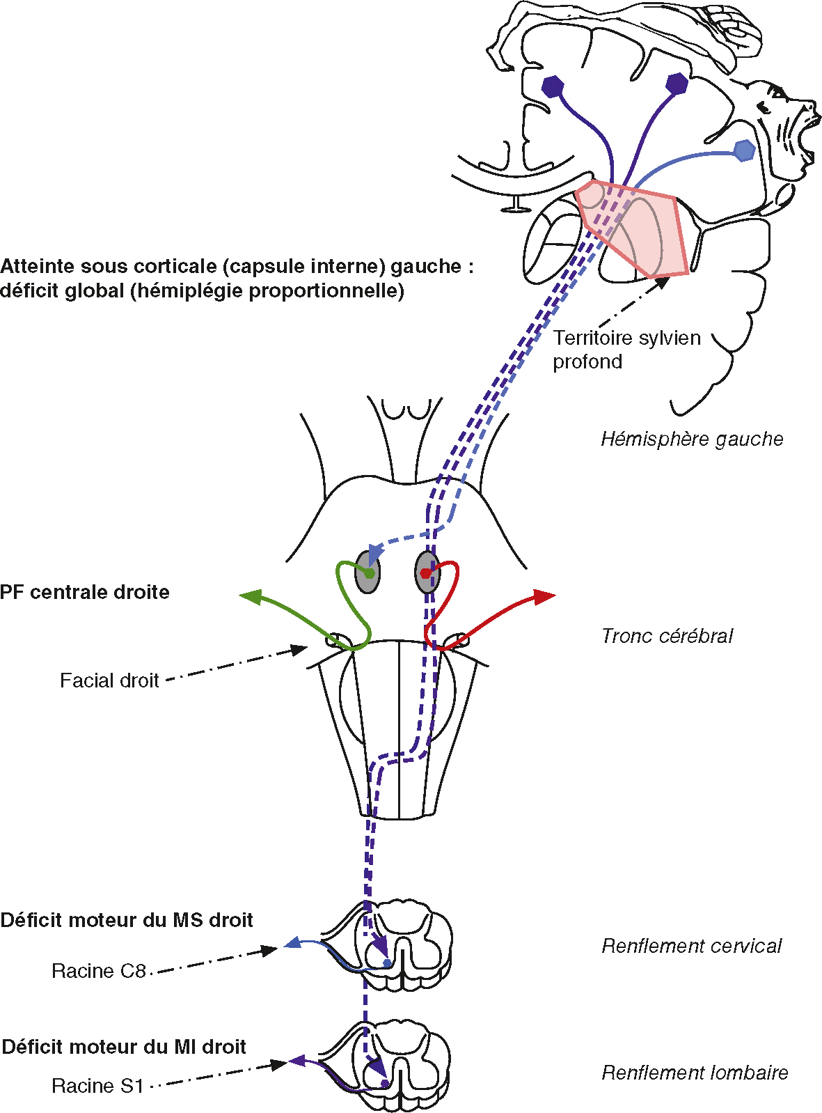 Schéma d’une lésion capsulaire interne gauche entraînant une hémiplégie proportionnelle droite touchant face, bras et jambe.