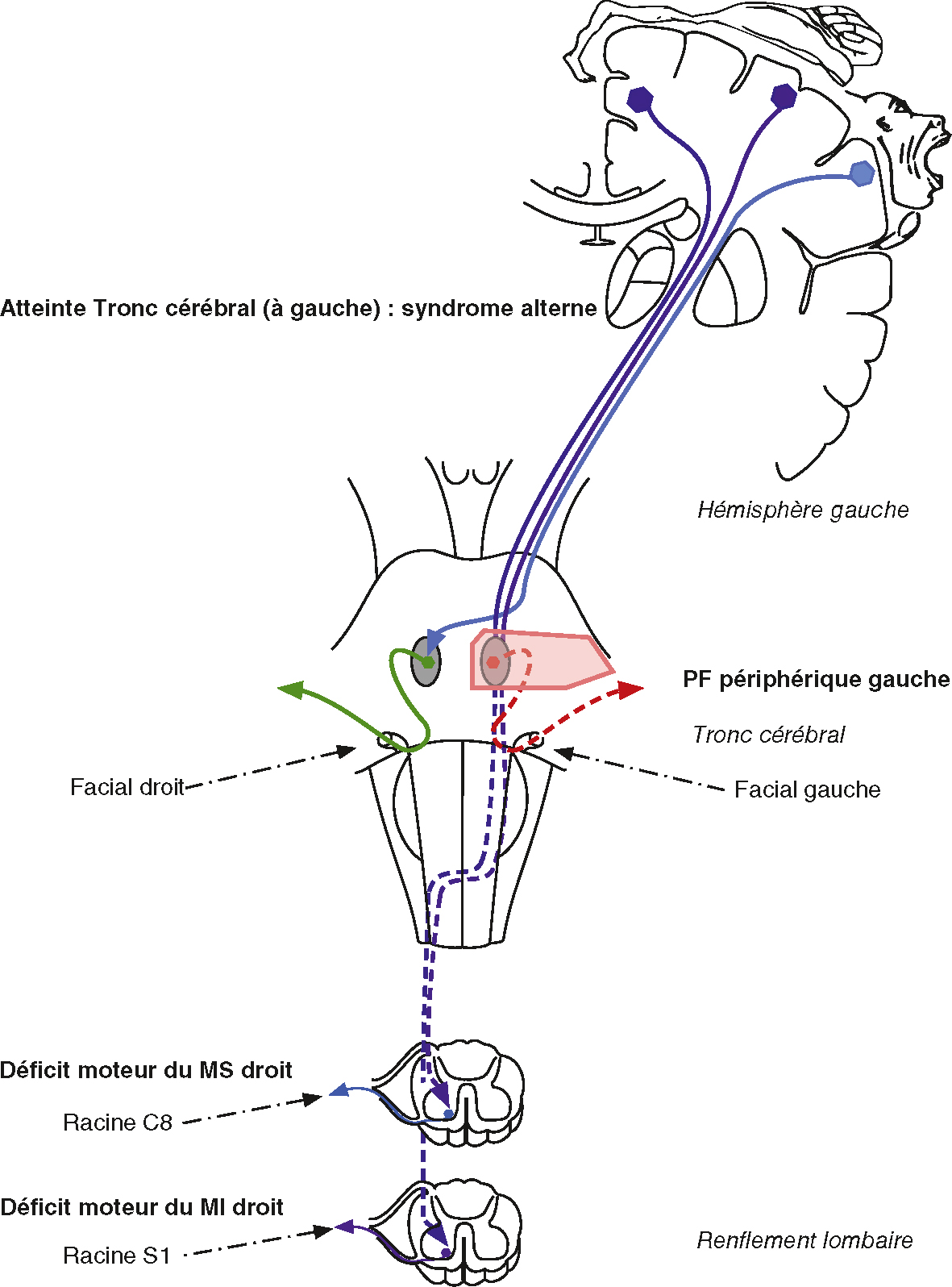Schéma illustrant un syndrome alterne du tronc cérébral gauche, associant paralysie faciale homolatérale et déficit moteur controlatéral.