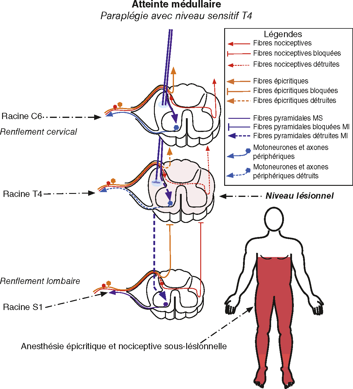 Schéma d’une lésion médullaire avec paraplégie sous T4, illustrant l’interruption des voies motrices et sensitives et la zone d’anesthésie corporelle associée.