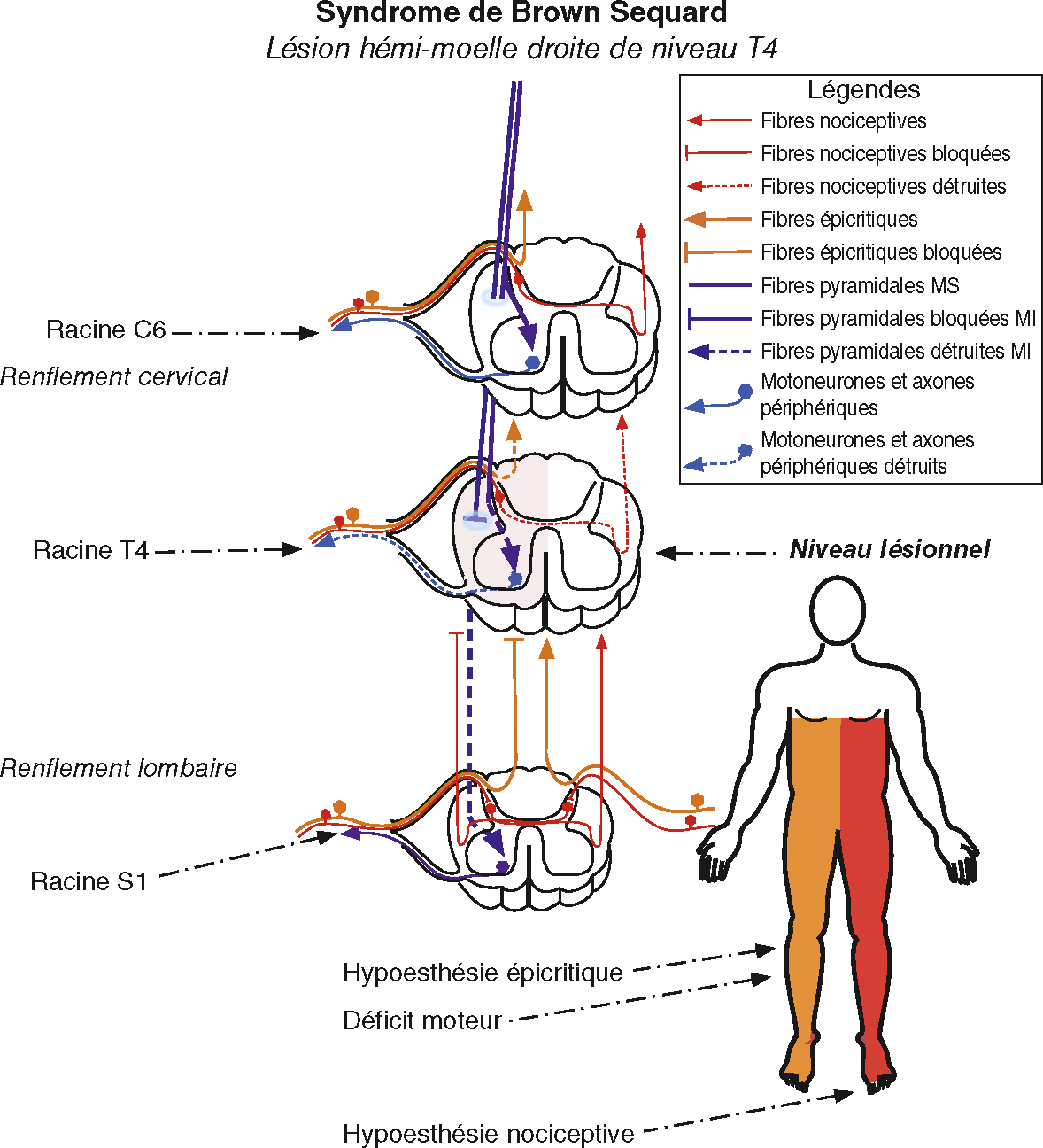 Lésion médullaire droite T4 entraînant déficit moteur droit et perte de sensibilité nociceptive gauche sous le niveau atteint.