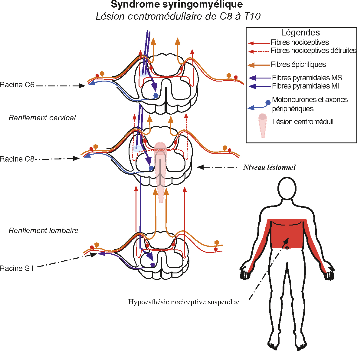 Schéma montrant une atteinte centromédullaire de C8 à T12 avec hypoesthésie suspendue bilatérale typique d’un syndrome syringomyélique.