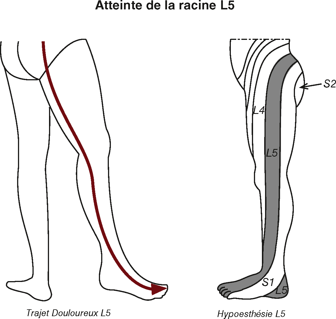 Schéma illustrant la douleur et l’hypoesthésie liées à l’atteinte de la racine L5, avec localisation précise des zones sensibles sur la jambe gauche.