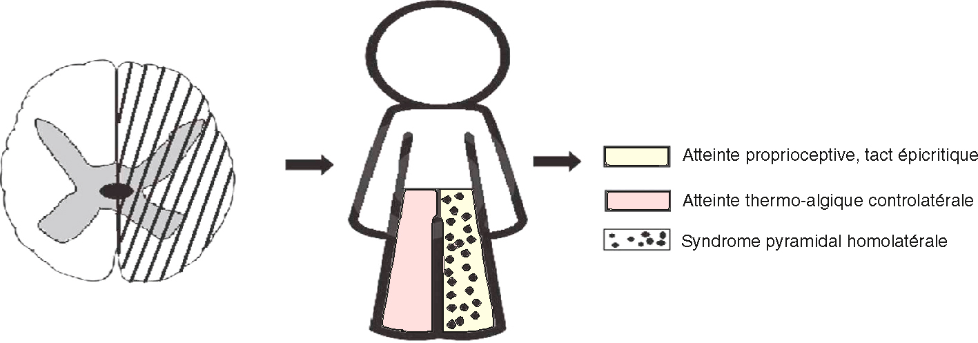 Atteinte médullaire unilatérale causant une perte motrice et sensitive homolatérale, et une hypoesthésie thermo-algésique controlatérale.