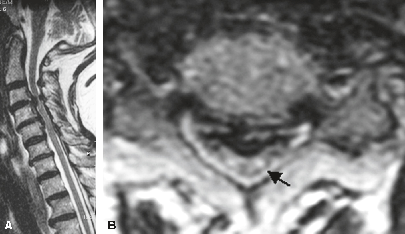 IRM sagittale et axiale montrant une myélopathie cervicarthrosique avec compression médullaire et hypersignal intramédullaire en T2, évocateur d’une atteinte chronique.