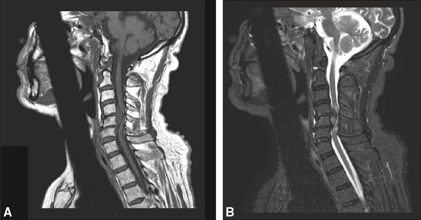 IRM cervicale montrant une hernie discale exclue C5-C6 avec compression médullaire et hypersignal intramédullaire T2.
