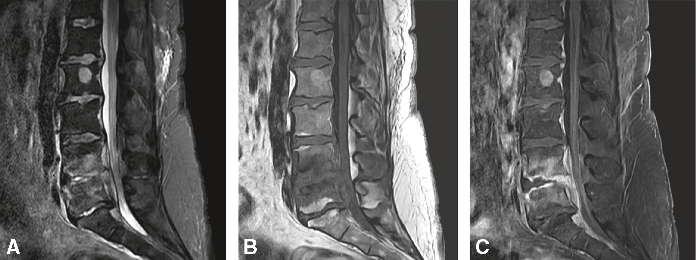 IRM montrant une spondylodiscite avec compression de la queue de cheval, typique d’une infection à staphylocoques.