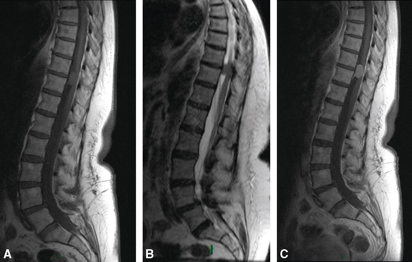 IRM montrant un méningiome intrarachidien prenant le contraste à T10-T11, refoulant la moelle sans l’envahir.