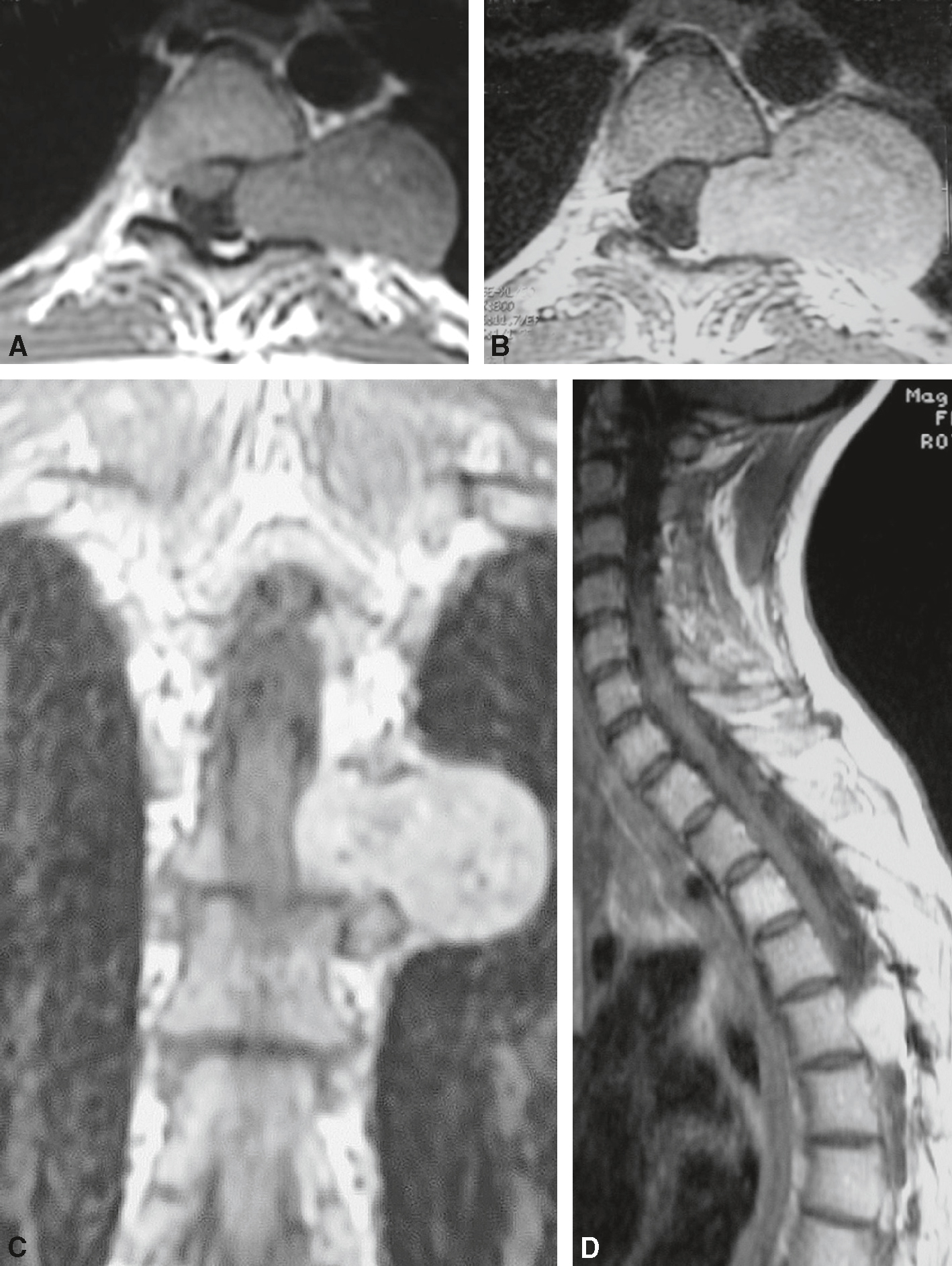 IRM montrant un schwannome en sablier gauche T5-T6, refoulant la moelle sans envahissement, typique d’une tumeur nerveuse bénigne foraminale.