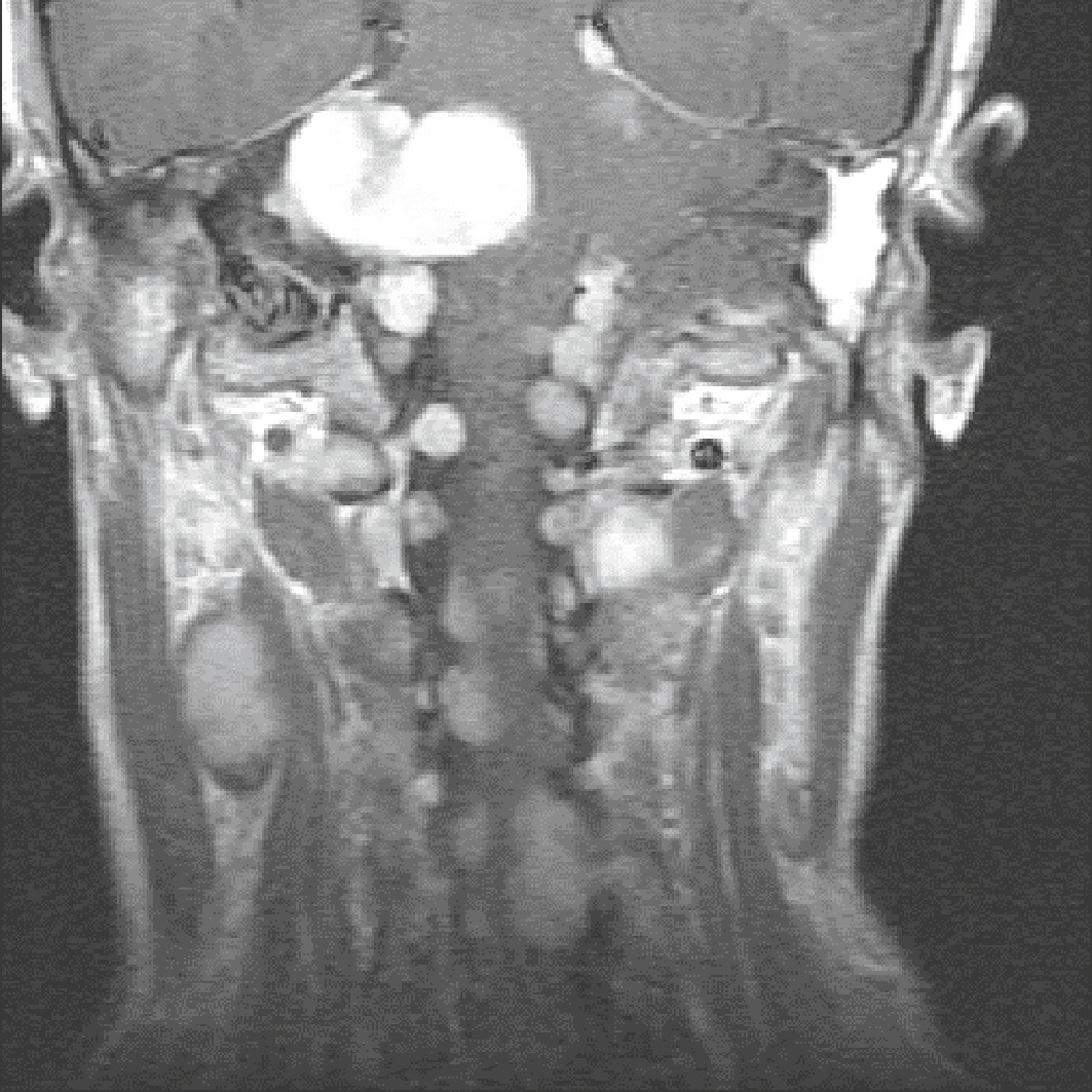 IRM montrant de multiples neurofibromes cervicaux responsables d’une compression médullaire dans un contexte de neurofibromatose de type 1.