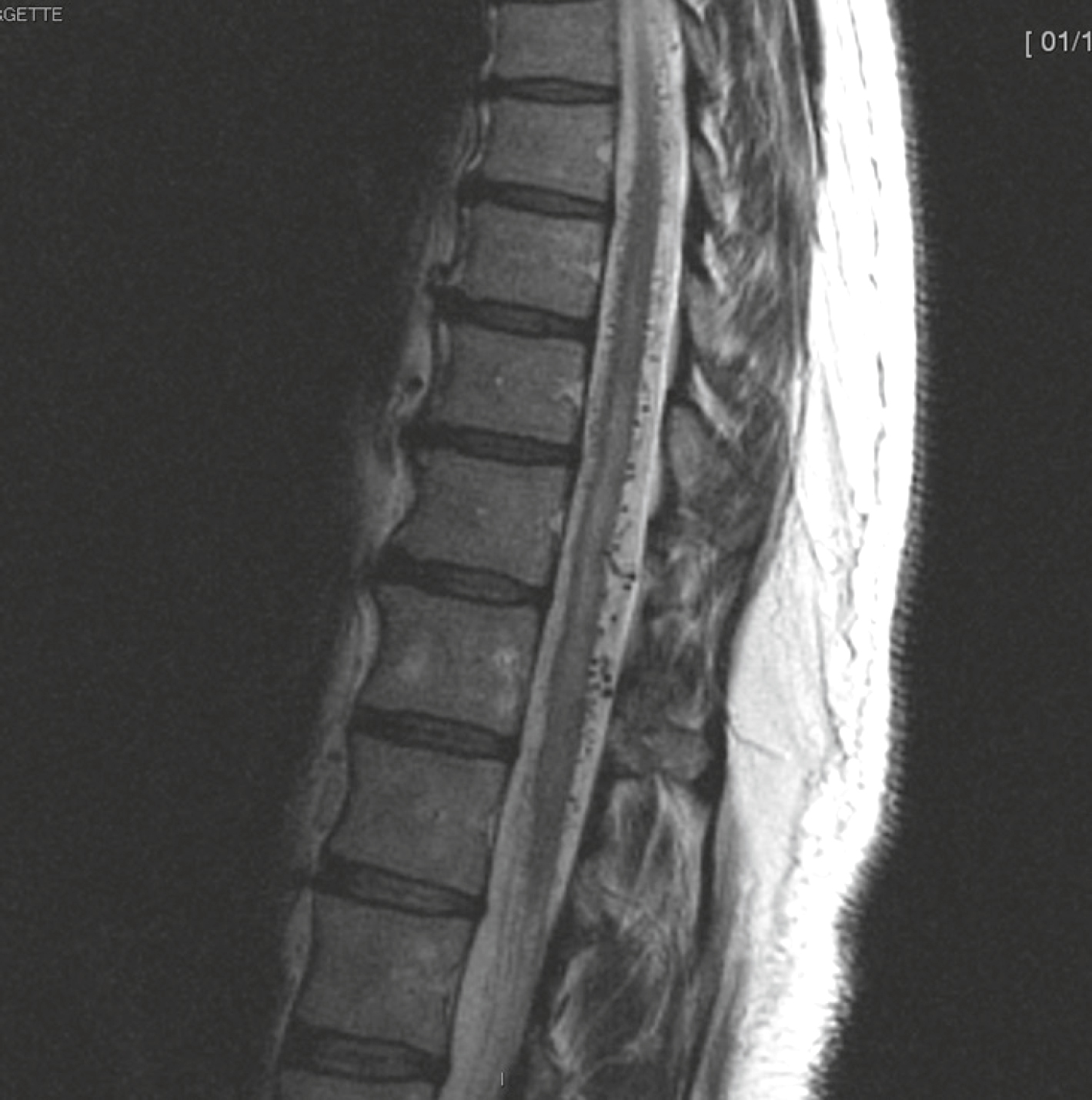 IRM T2 montrant une congestion médullaire et des vaisseaux dilatés, évocateurs d’une fistule durale spinale avec myélopathie congestive.