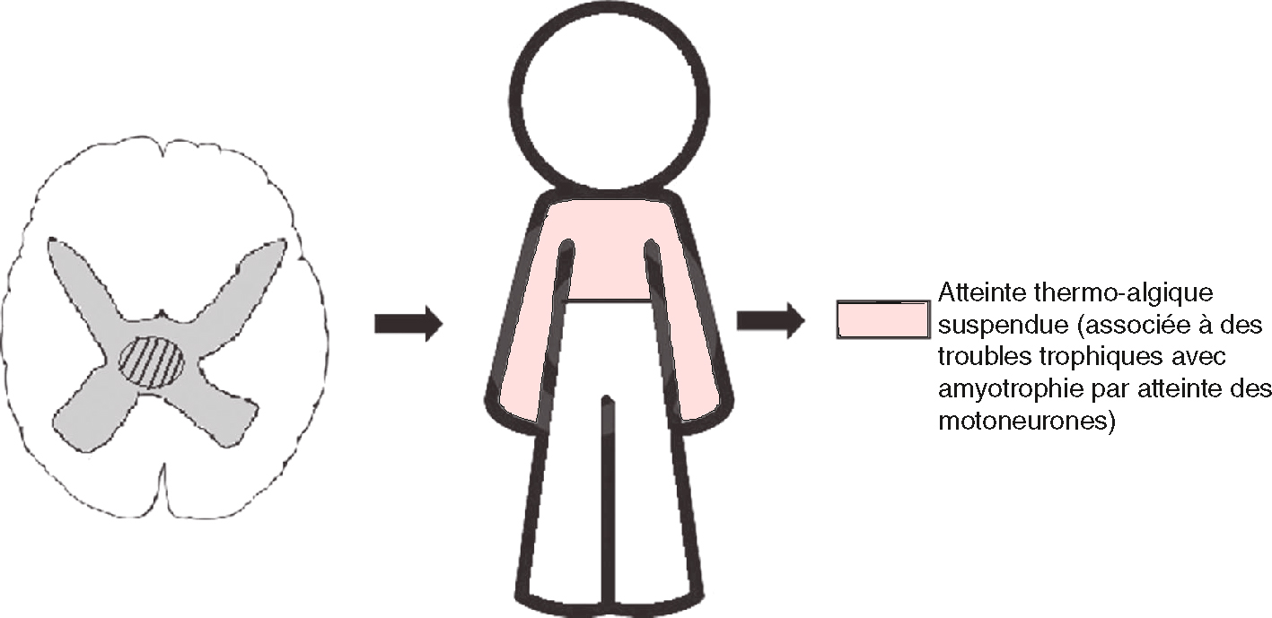 Schéma illustrant une atteinte suspendue thermo-algésique dans la syringomyélie avec amyotrophie segmentaire.