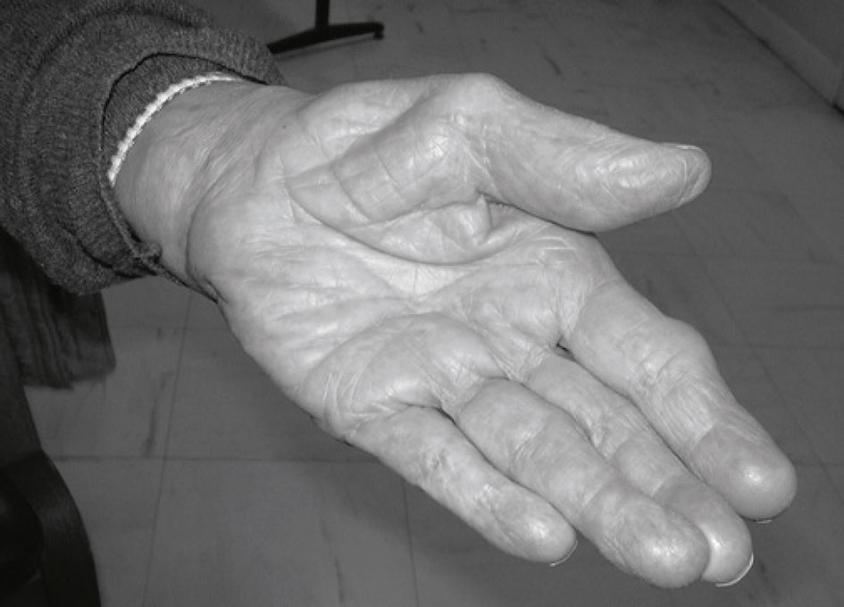 Main gauche montrant une amyotrophie thénarienne nette. Aspect évocateur d’un syndrome du canal carpien avancé.
