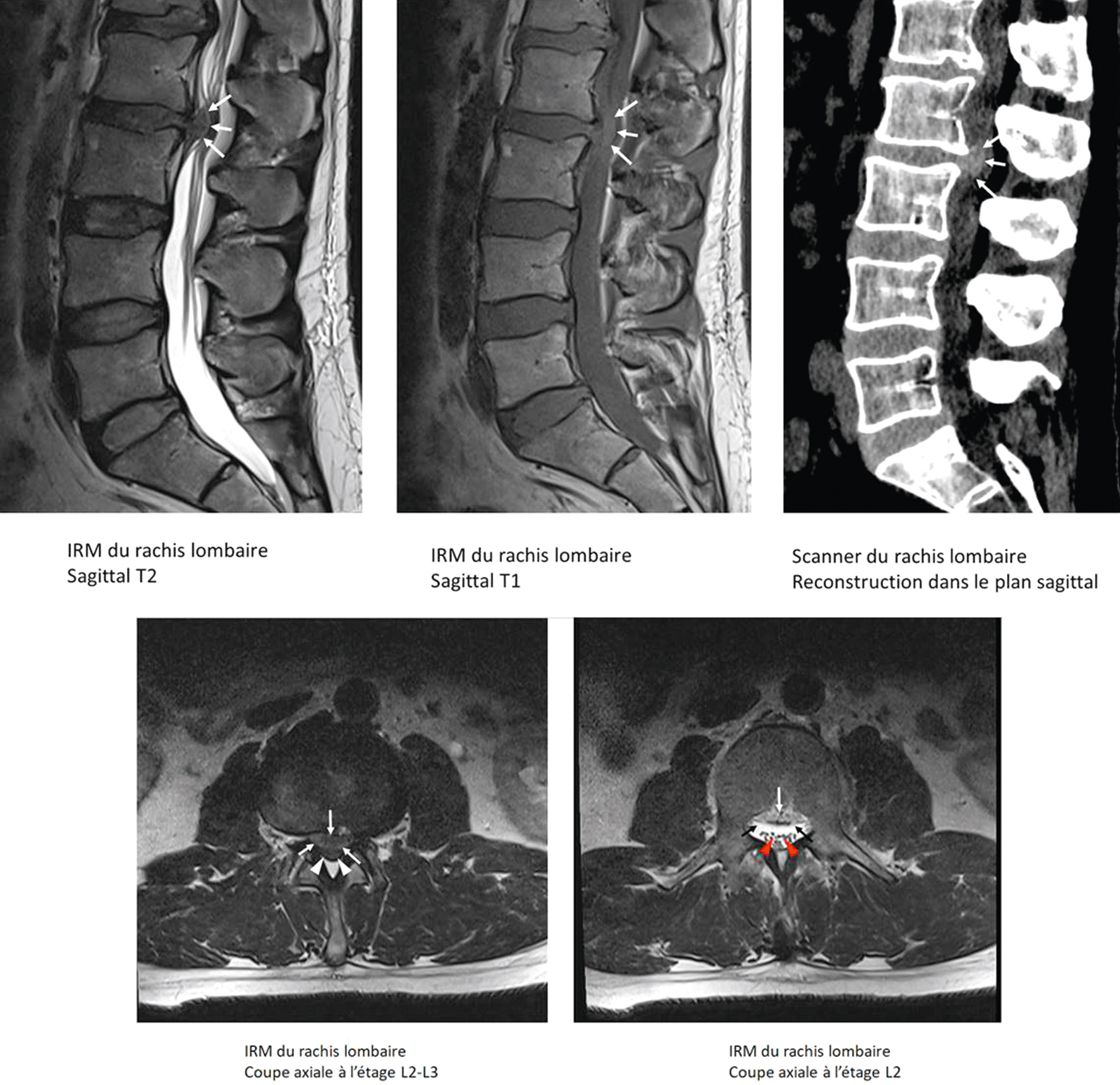 Les images combinées d’IRM et de scanner du rachis lombaire montrent une volumineuse hernie discale en L2-L3.