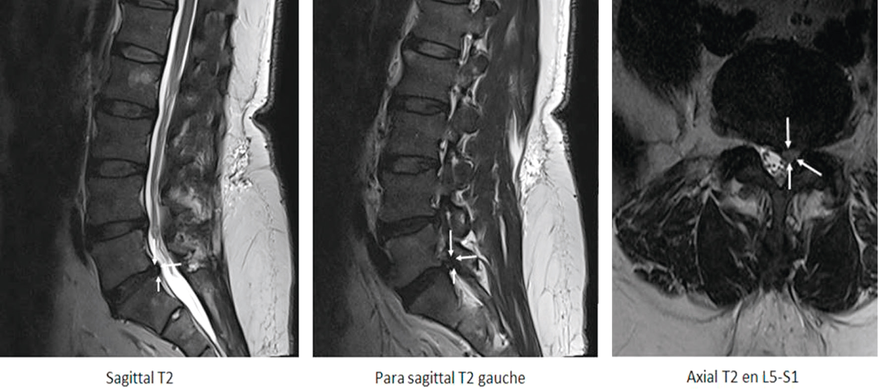 Hernie discale L5-S1 gauche comprimant la racine S1. Conflit foraminal gauche visible en sagittal et axial T2.