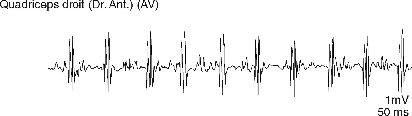 Tracé EMG du quadriceps droit avec potentiels polyphasiques fréquents. Aspect compatible avec une dénervation chronique et réinnervation en cours.