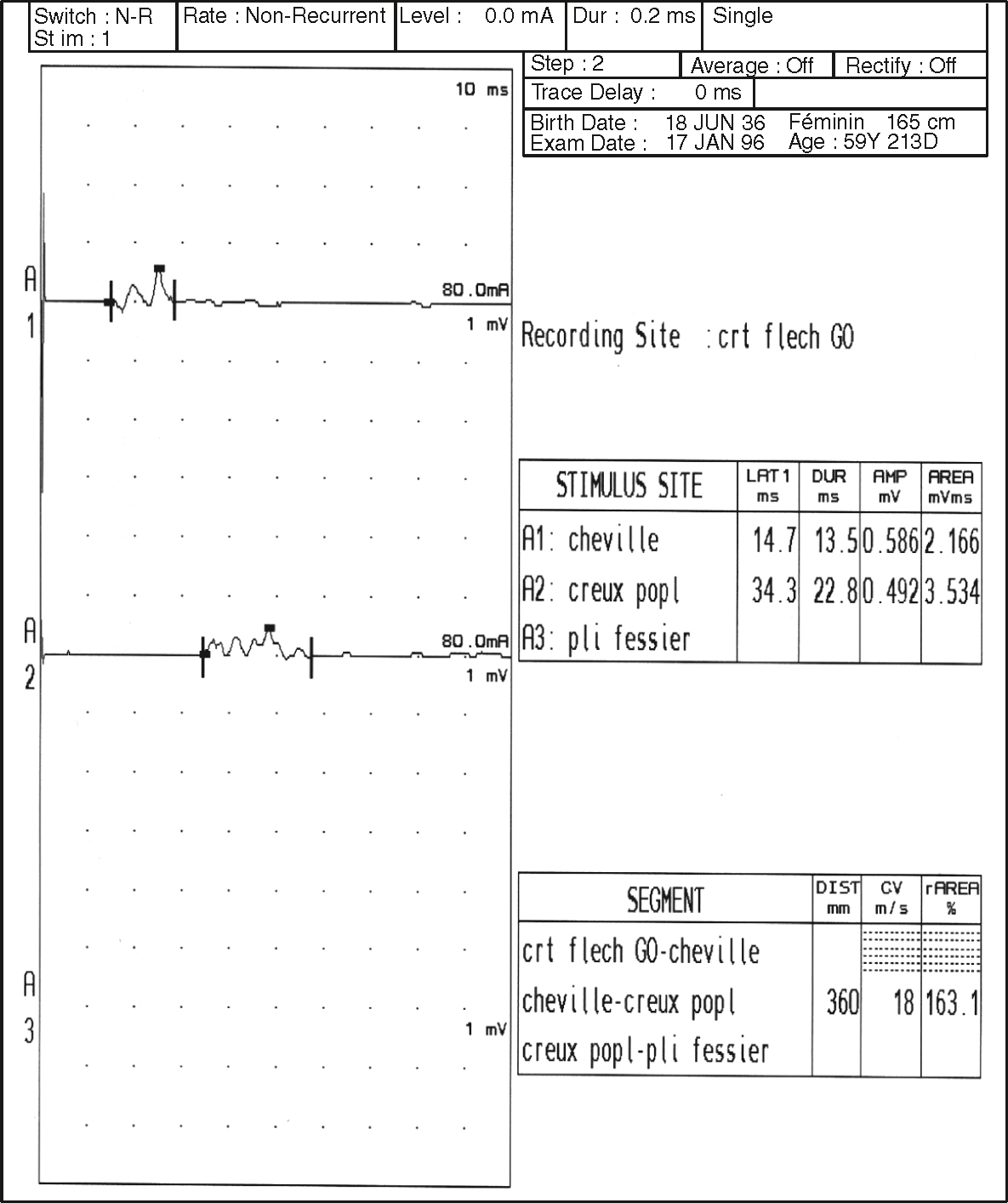 Allongement de la latence distale et ralentissement marqué de la conduction motrice du nerf fibulaire, suggérant une atteinte neuropathique significative.