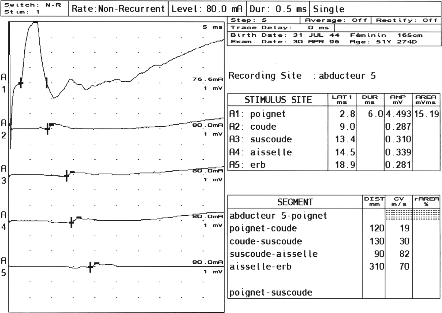 ENMG moteur du nerf ulnaire avec enregistrement sur l'abducteur du 5e doigt. Cinq stimulations de A1 (poignet) à A5 (plexus brachial) ont été effectuées.