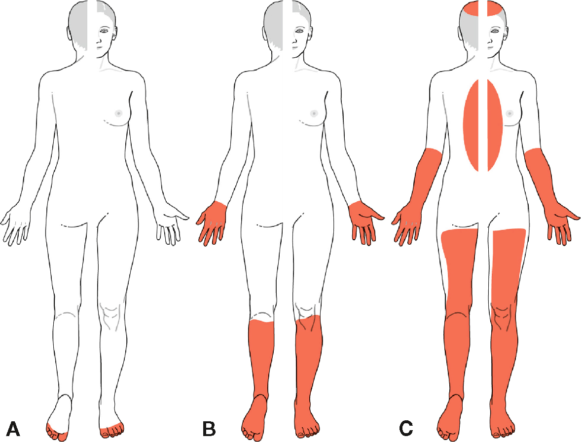 Représentation des zones corporelles touchées dans les polyneuropathies, allant d’une atteinte distale à une extension proximale ou tronculaire.