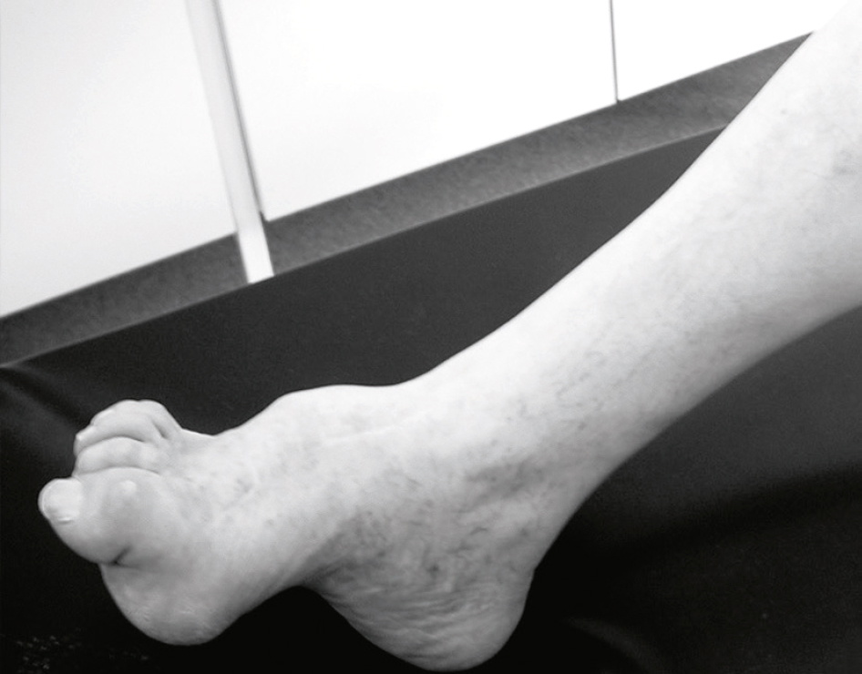 Déformation en pied creux avec griffes d’orteils et amyotrophie distale, typique d’une neuropathie de Charcot-Marie-Tooth, entraînant une instabilité et des troubles moteurs.