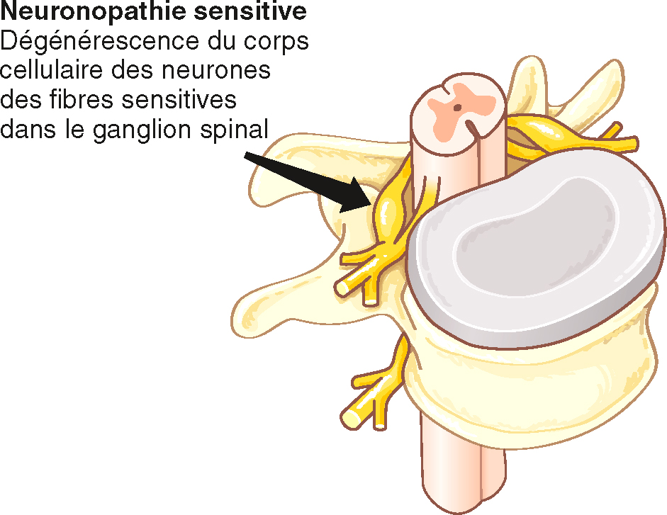 Dégénérescence neuronale localisée dans le ganglion spinal, siège des corps cellulaires des fibres sensitives périphériques.