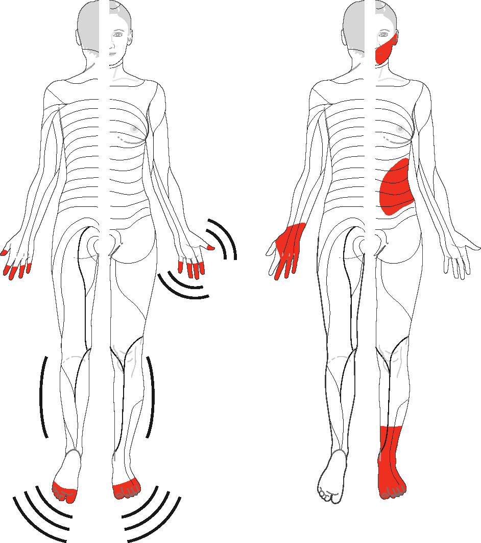 Illustration des troubles sensitifs dans les neuronopathies. Atteinte distale symétrique touchant les quatre membres.