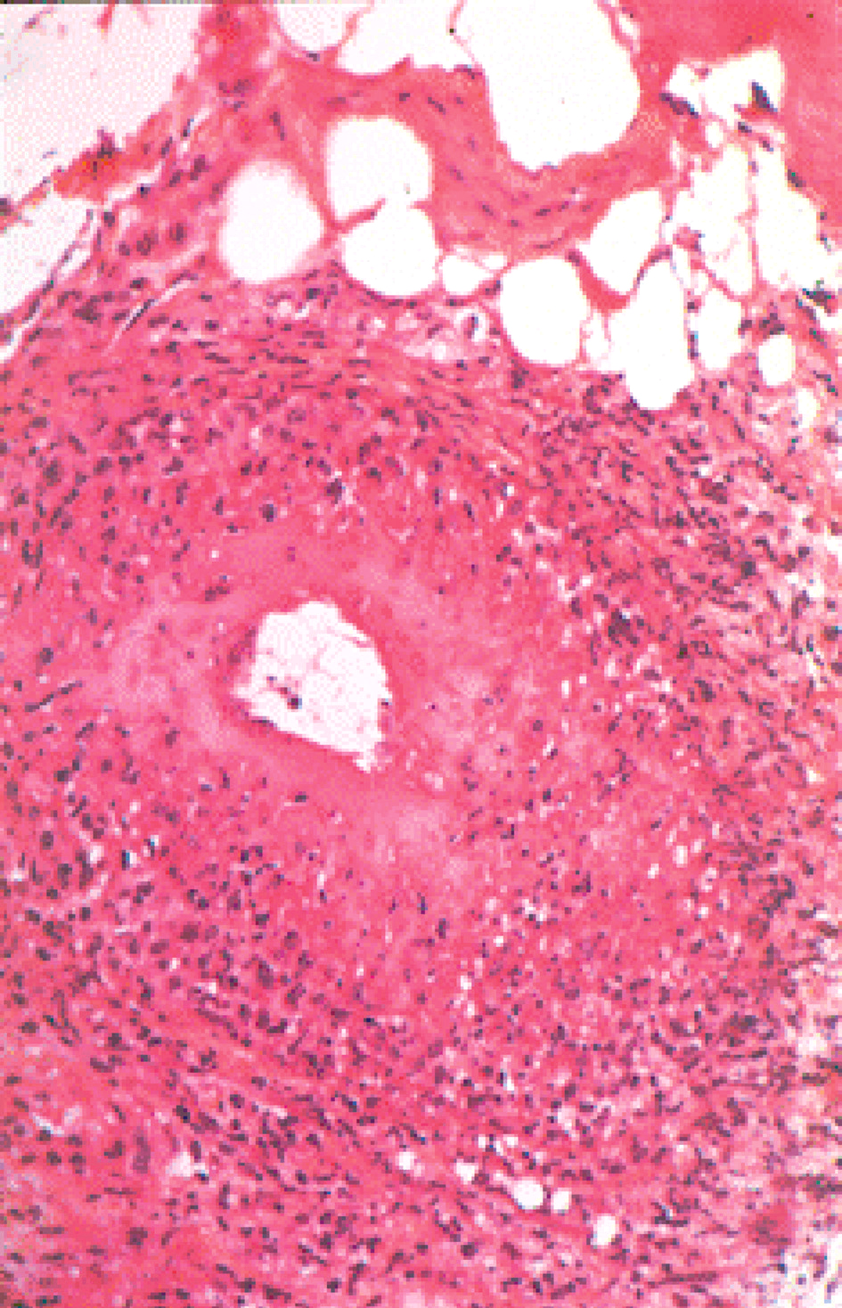Biopsie nerveuse montrant une vascularite active, avec infiltrat inflammatoire périvasculaire et nécrose fibrinoïde artérielle.