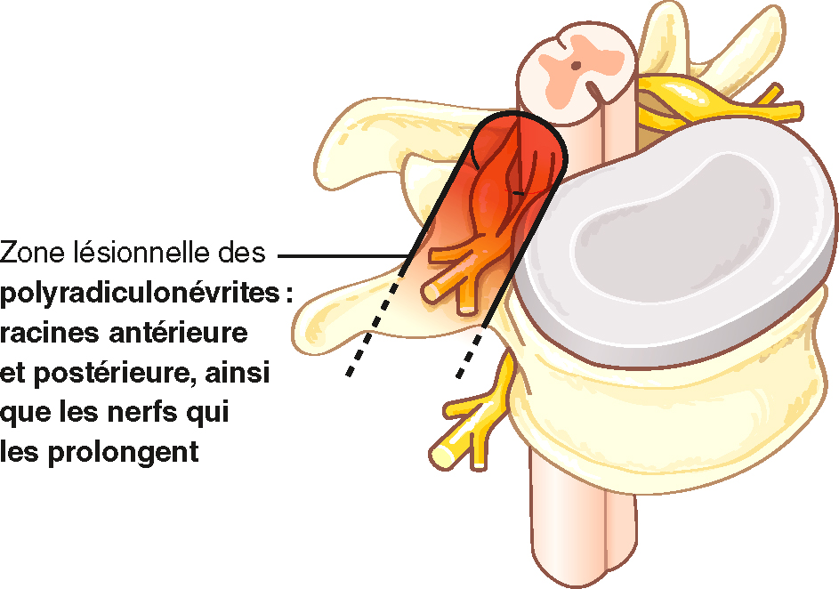 Schéma d’atteinte des racines dans les polyradiculonévrites. Atteinte des racines antérieures, postérieures et nerfs périphériques.