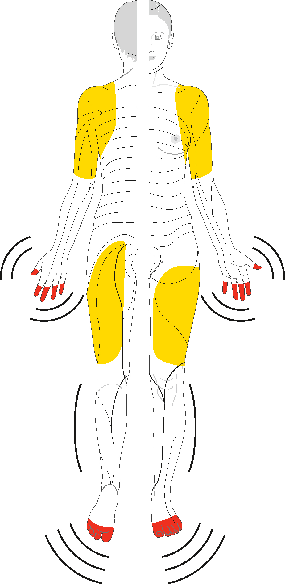 Répartition ascendante et distale des atteintes motrices et sensitives dans le syndrome de Guillain-Barré à expression sensitivo-motrice aiguë.