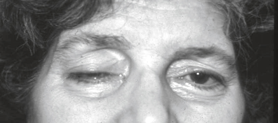 Ptosis marqué de la paupière supérieure droite avec asymétrie oculaire visible et œil gauche ouvert.