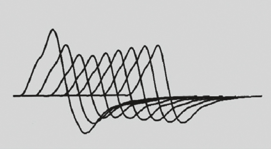 Tracés électromyographiques montrant un décrément d’amplitude. Indique une anomalie de la transmission neuromusculaire.