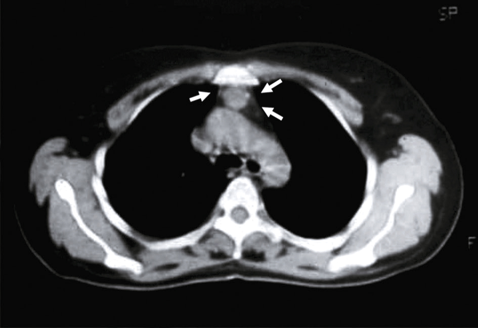 Scanner thoracique montrant une masse rétro-sternale homogène évocatrice d’un thymus hyperplasique résiduel, sans signe d’invasion.