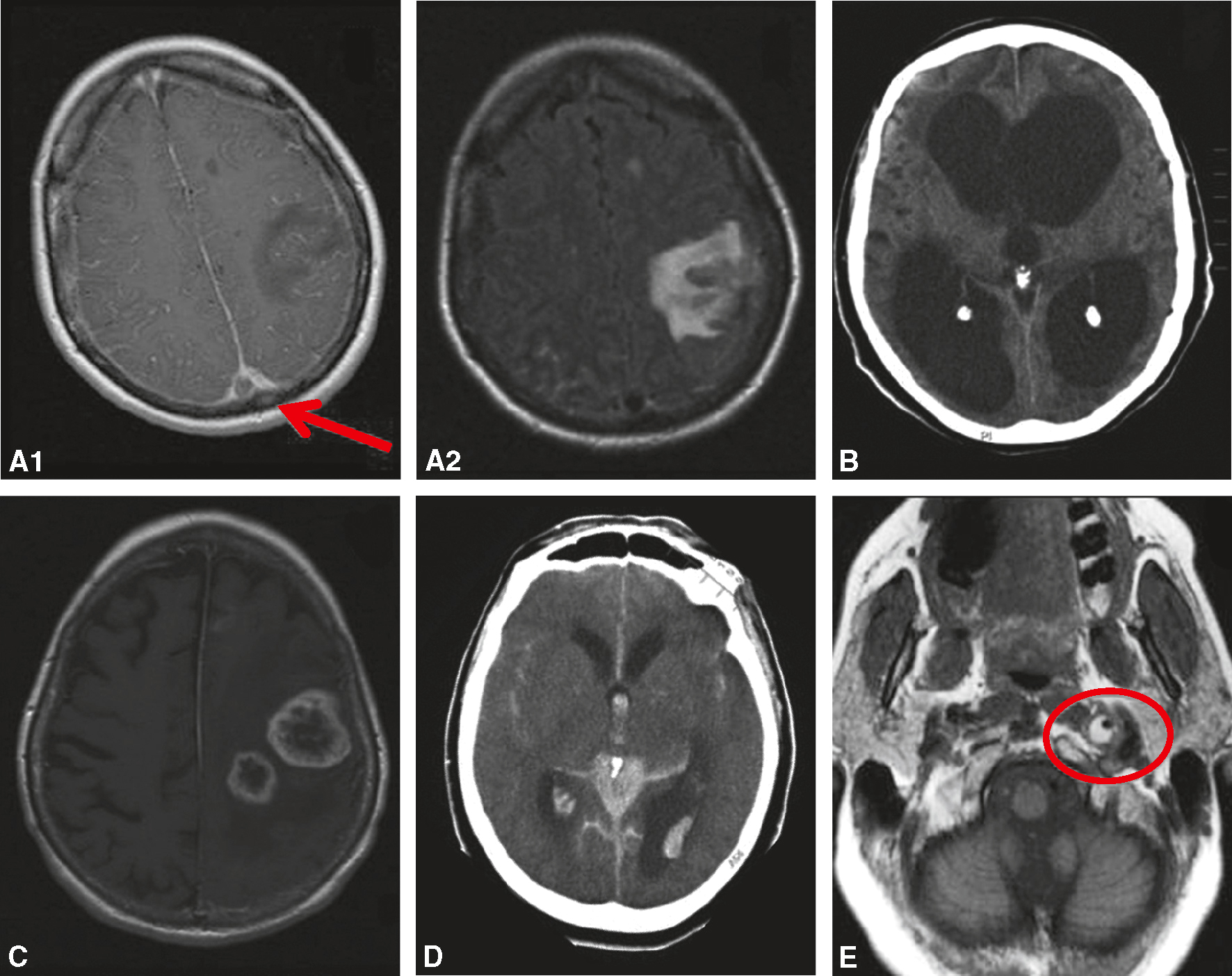 L'image présente des exemples d'imagerie cérébrale de céphalées secondaires, montrant des lésions, des hémorragies et des anomalies dans différents lobes cérébraux pour un diagnostic précis.