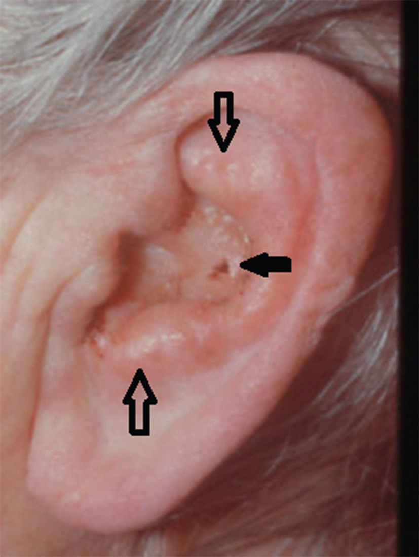 L'éruption vésiculaire de l'oreille peut être causée par le zona oticus, des allergies ou une dermatite de contact, provoquant douleur, démangeaisons et parfois paralysie faciale.