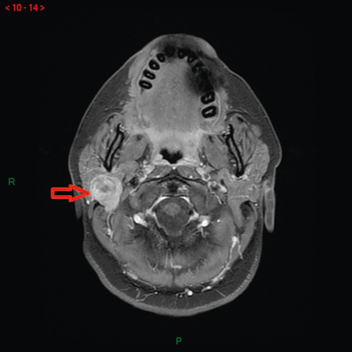 L'image montre une IRM cervicale en séquence T1 avec gadolinium, améliorant la visibilité des structures internes du cou, permettant un diagnostic précis d'anomalies ou inflammations.
