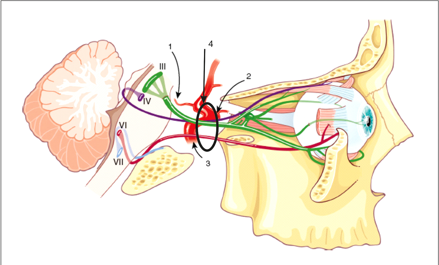 Les nerfs crâniens III, IV et VI contrôlent les muscles oculomoteurs, permettant des mouvements oculaires précis pour la vision binoculaire et la stabilisation du regard.