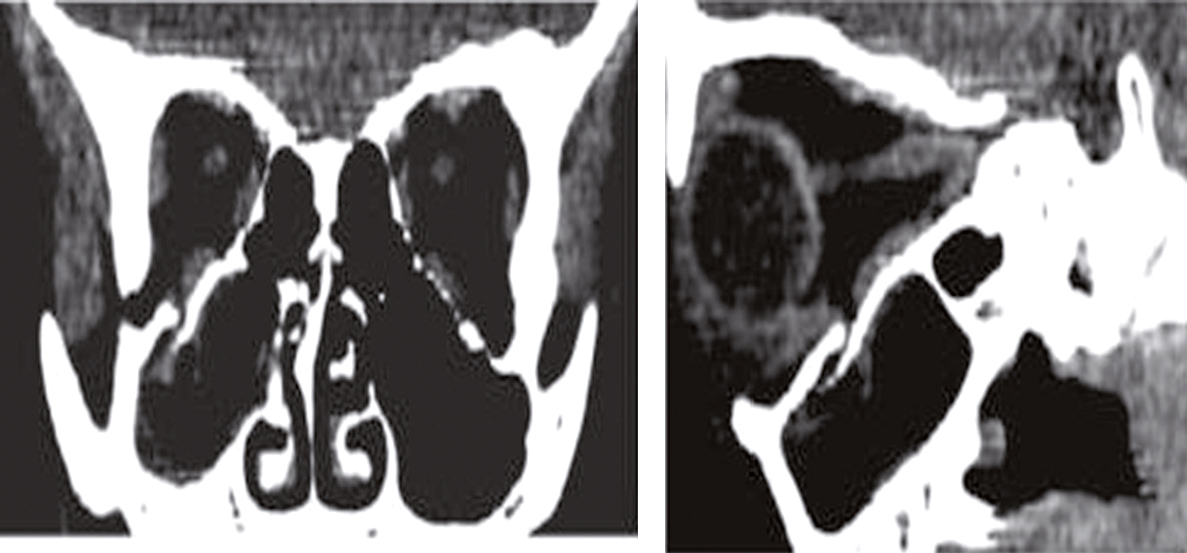 Une fracture du plancher de l'orbite résulte d'un traumatisme, causant douleur, gonflement, ecchymoses et vision double. Le traitement varie de conservateur à chirurgical selon la gravité.