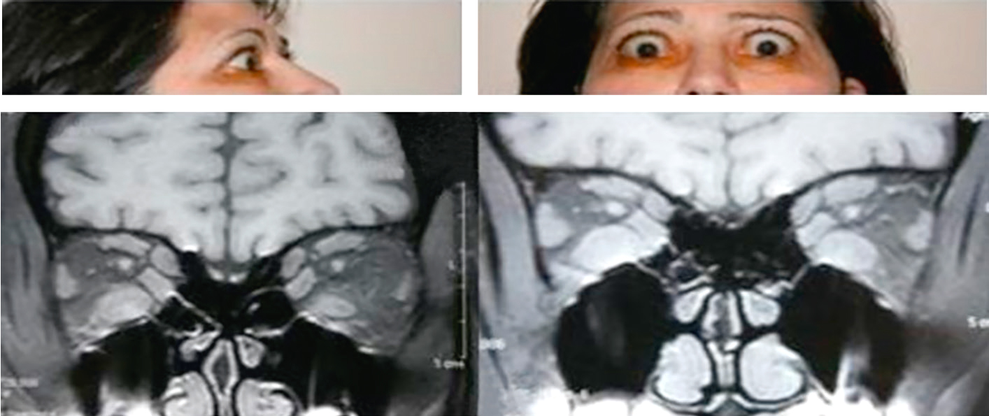 L'orbithopathie dysthyroïdienne, liée à la thyroïdite de Basedow, cause exophtalmie, diplopie, sécheresse oculaire. Le traitement inclut médicaments et chirurgie.