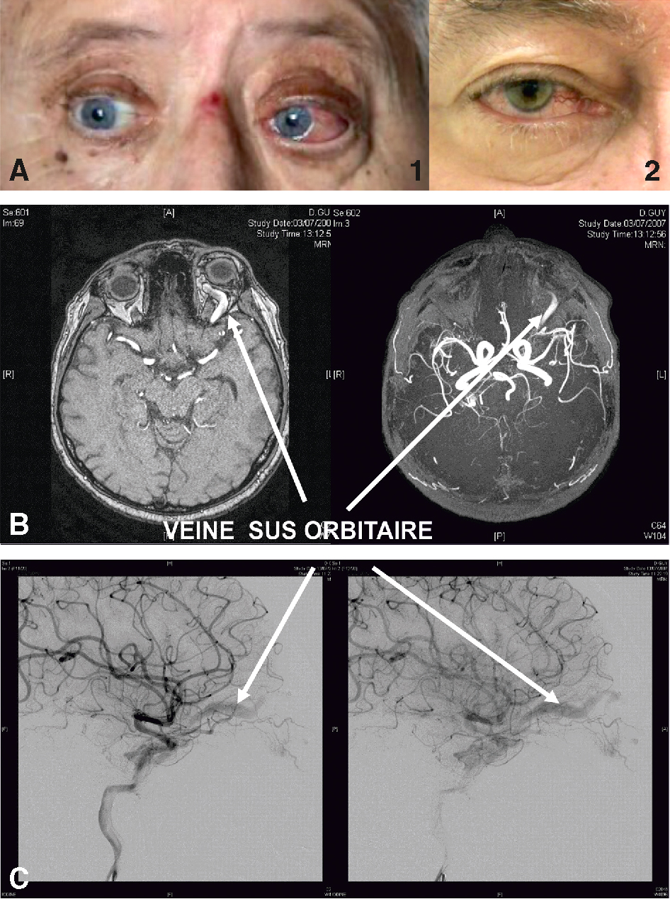 Une fistule carotidocaverneuse est une connexion anormale entre l'artère carotide et le sinus caverneux, entraînant des symptômes oculaires et une congestion veineuse.