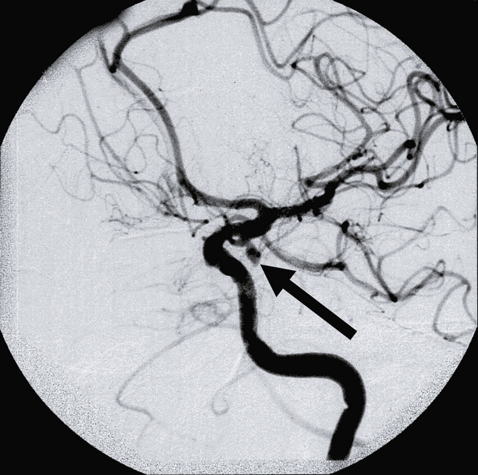 L'angiographie montre un anévrisme supraclinoïdien affectant le nerf III gauche, causant diplopie, ptose et douleur. L'angiographie est essentielle pour le diagnostic et le traitement.